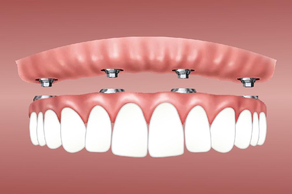 Implanty zębowe - co warto o nich wiedzieć?