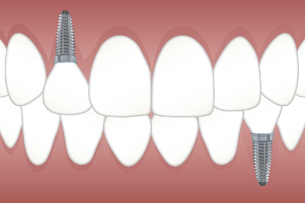 Implanty zębowe - co warto o nich wiedzieć?